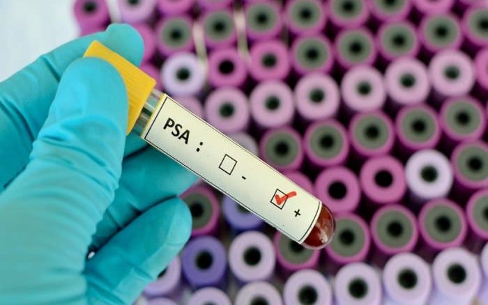 PSA antigeno prostático