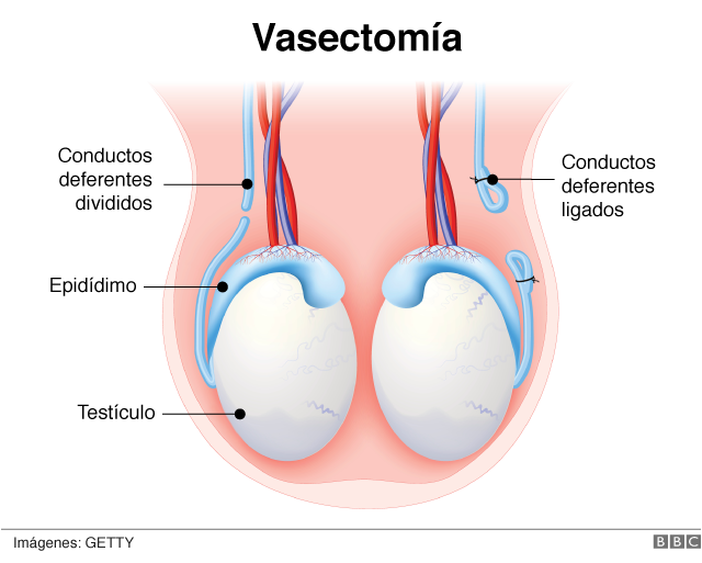 la vasectomía